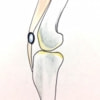 膝蓋靱帯縫縮前