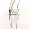 膝蓋靱帯縫縮後
