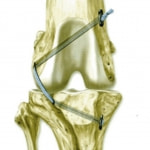 タイトロープ法