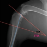 TPLO