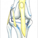 スーチャーアンカー法