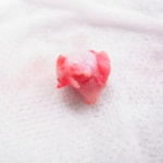 切除された大腿骨頭